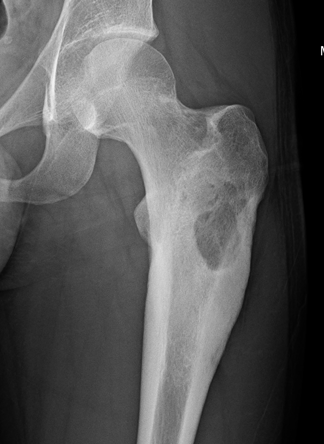 Osteoblastoma The Bone School